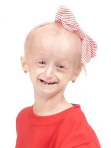 14_FOTO - Progeria Carly Cares